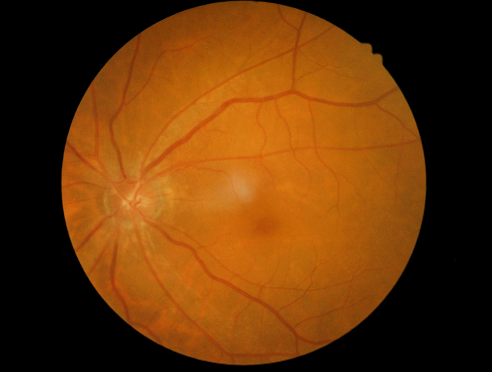 Retinal Imaging at Crown Point Optometry.